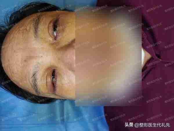 50岁先生做外切祛眼袋手术真实记录，术后7天实拍，无美颜、无P图