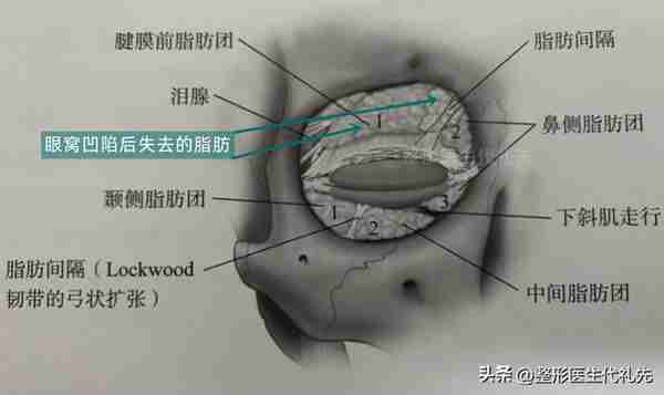 上眼睑眶隔脂肪释放填充眼窝凹陷，并不适合所有人