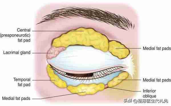 上眼睑眶隔脂肪释放填充眼窝凹陷，并不适合所有人
