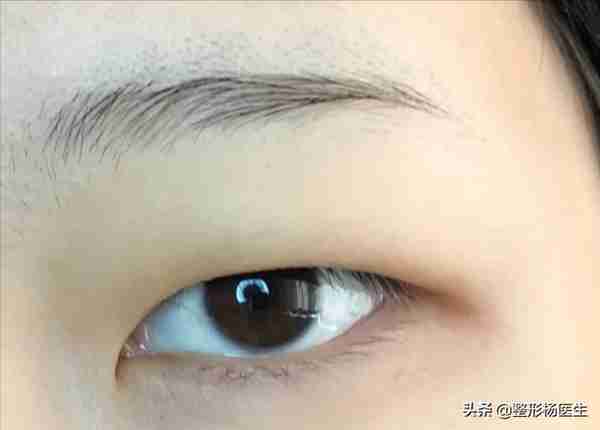 肿眼泡做埋线双眼皮效果不好？这是为什么呢？