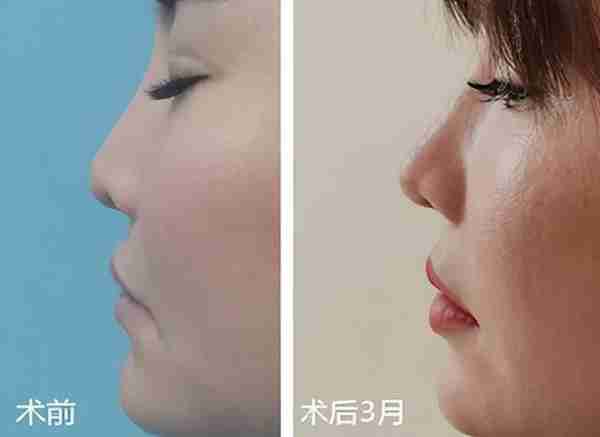 第一次做鼻子失败,修复过程全分享，过来人告诉你句句都是大实话