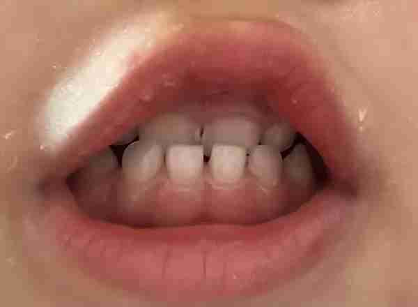 不是所有牙齿不齐都需要“正畸”！这5种牙齿，别急着矫正