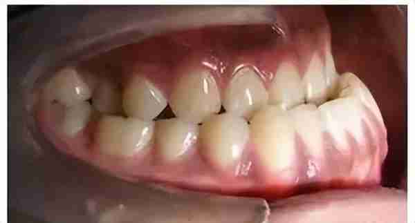 不是所有牙齿不齐都需要“正畸”！这5种牙齿，别急着矫正