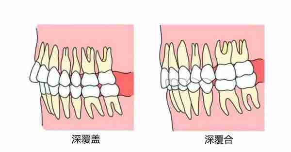 年龄越大，龅牙就越明显越严重？专家分析：这五大原因引起！