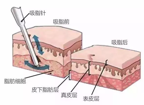 韩啸医生详解大腿吸脂快速瘦腿的并发症及注意事项