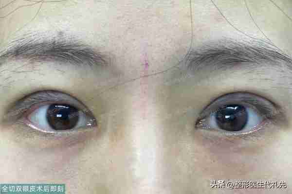 40岁女性的美丽新生：全切双眼皮手术让我恢复自信！