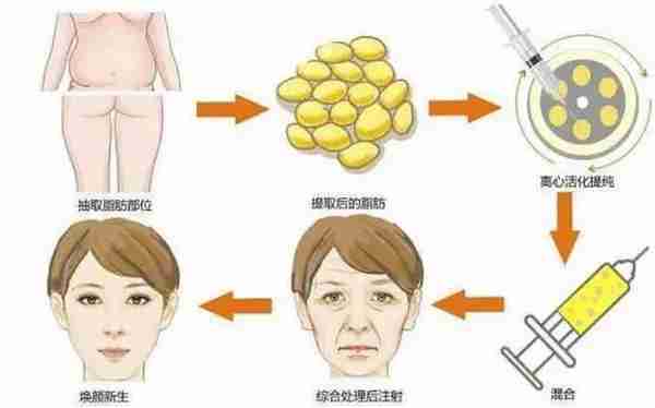 自体脂肪填充的快问快答 8个问题，总有你想问的在这里