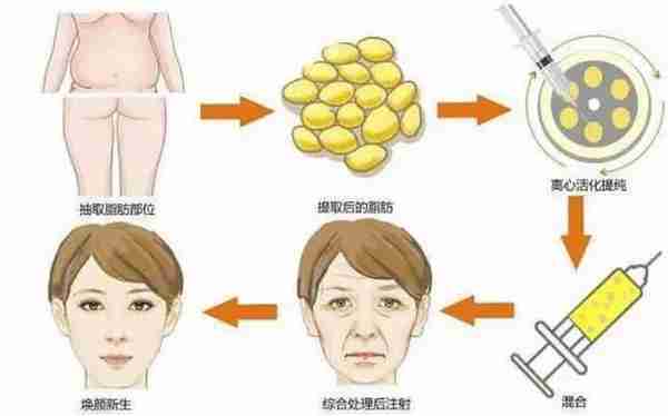 自体脂肪填充的快问快答 8个问题，总有你想问的在这里