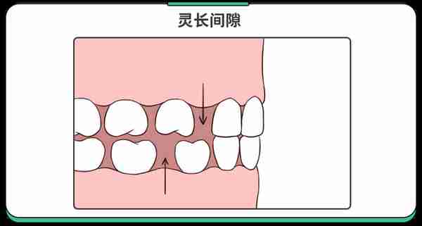 不是所有牙齿不齐都需要“正畸”！这5种牙齿，别急着矫正