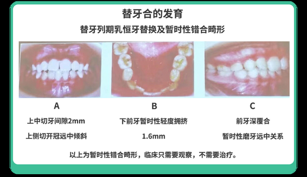 不是所有牙齿不齐都需要“正畸”！这5种牙齿，别急着矫正