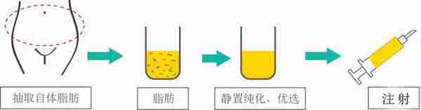 关于自体脂肪填充面部，你必须了解的几个问题