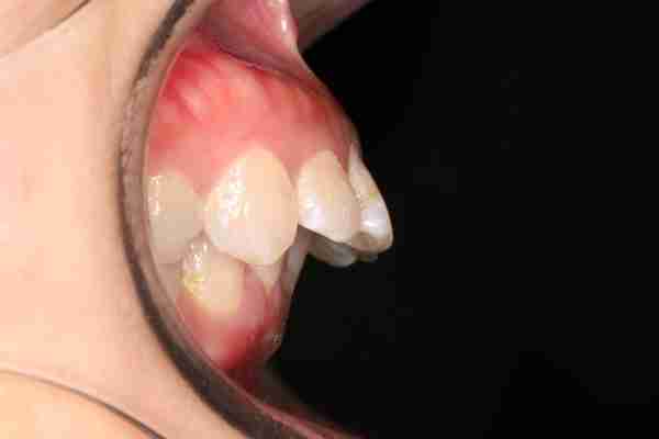 年龄越大，龅牙就越明显越严重？专家分析：这五大原因引起！