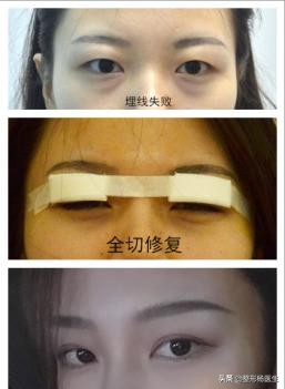 肿眼泡做埋线双眼皮效果不好？这是为什么呢？