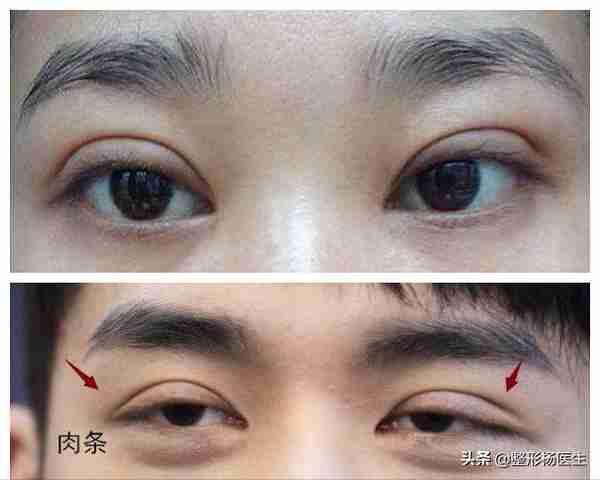 肿眼泡做埋线双眼皮效果不好？这是为什么呢？