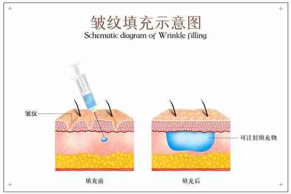 玻尿酸、自体脂肪、肉毒素，哪种除皱效果更好？