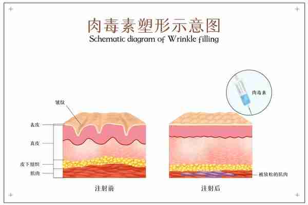 玻尿酸、自体脂肪、肉毒素，哪种除皱效果更好？