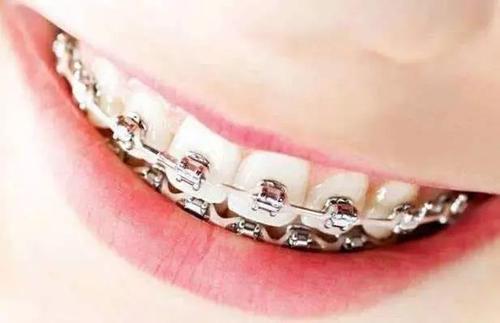 30岁以后，还能矫正牙齿吗？
