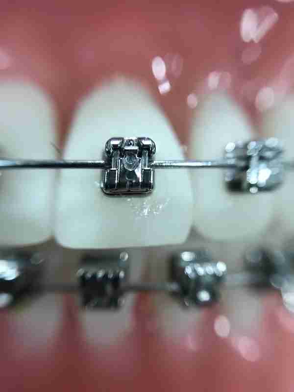 50岁做牙齿矫正有风险吗