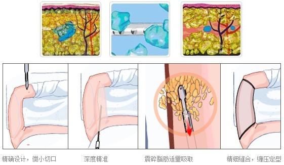 手臂吸脂手术后一般多久能恢复？