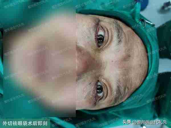 50岁先生做外切祛眼袋手术真实记录，术后7天实拍，无美颜、无P图