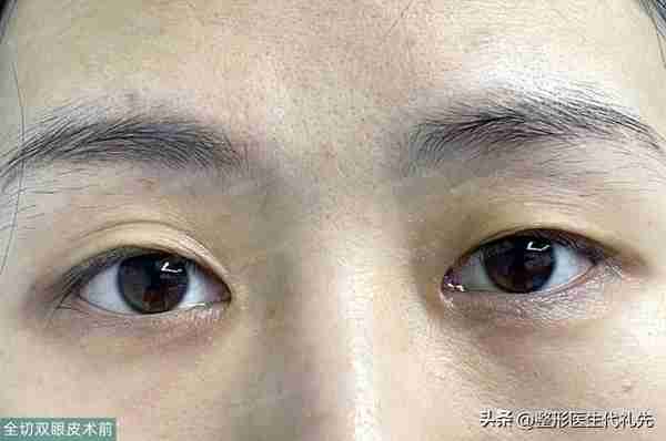 40岁女性的美丽新生：全切双眼皮手术让我恢复自信！