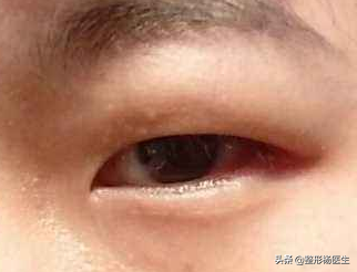 肿眼泡做埋线双眼皮效果不好？这是为什么呢？