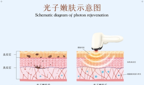 为什么做完光子嫩肤后会有反黑的现象